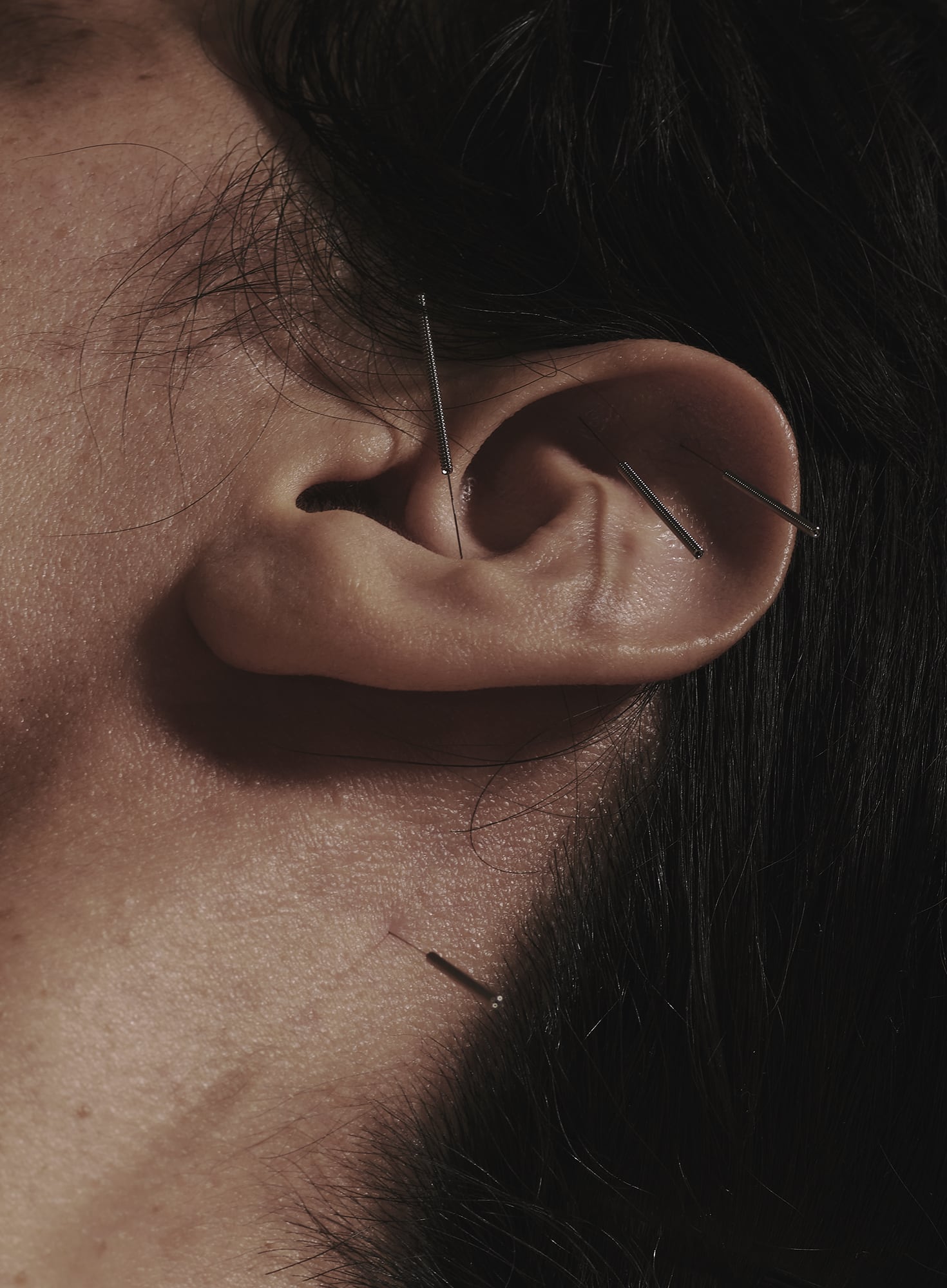 25-01-25_ZI-Accupuncture_0553_crop