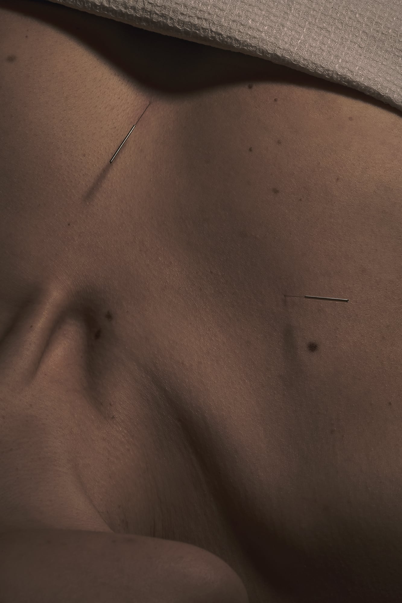 25-01-25_ZI-Accupuncture_0613